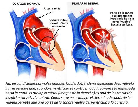 Insuficiencia de la válvula mitral: insuficiencia de la válvula cardíaca